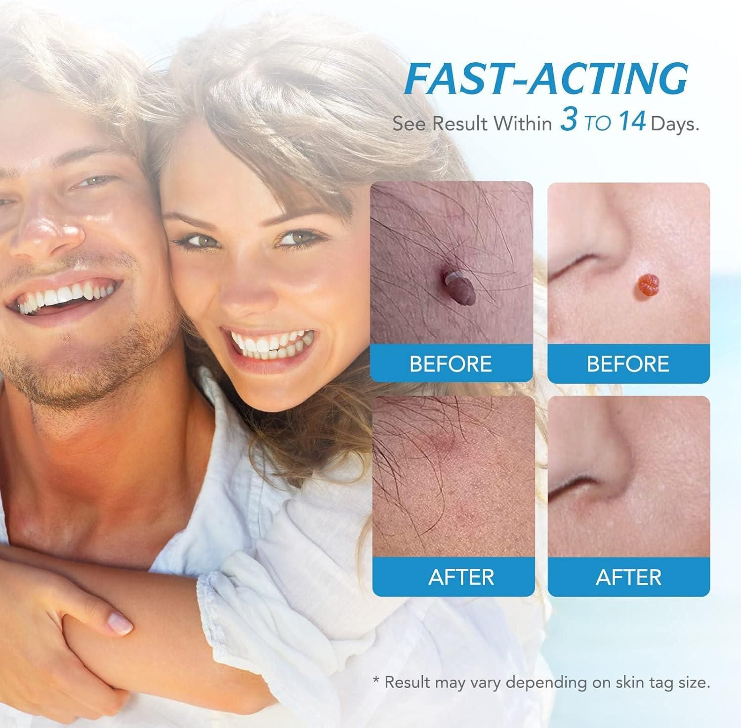 2 in 1 Skin Tag Remover Kit - Painless - Shopsmart9