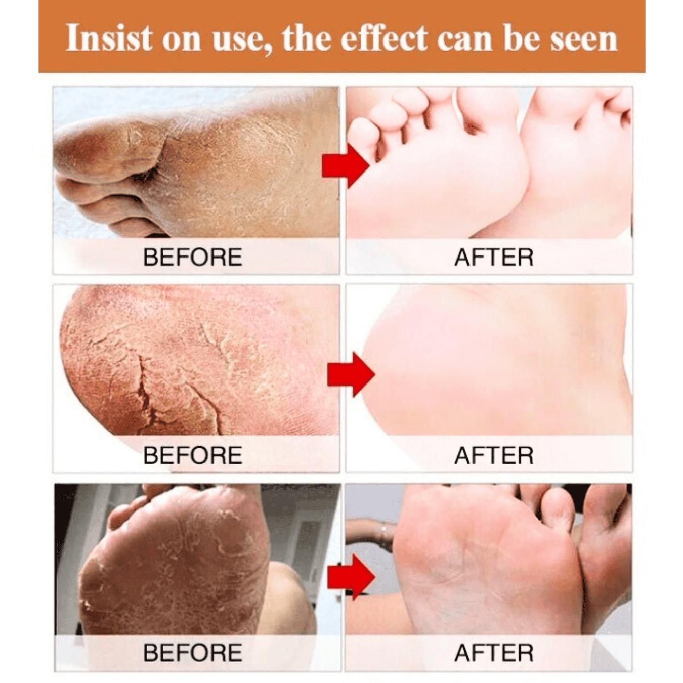 Foot Cream for Cracked and Dry Skin, Heel, Finger Healing Balm and Blaster - Shopsmart9