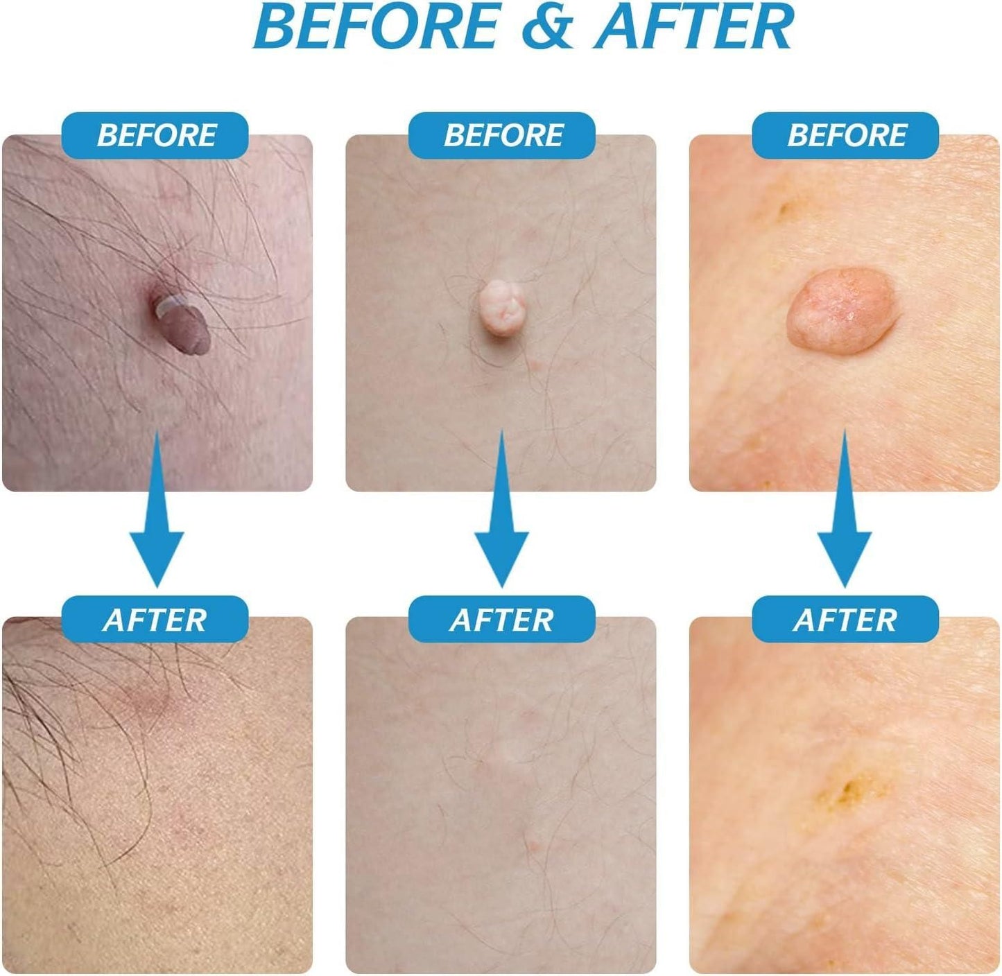 2 in 1 Skin Tag Remover Kit - Painless - Shopsmart9