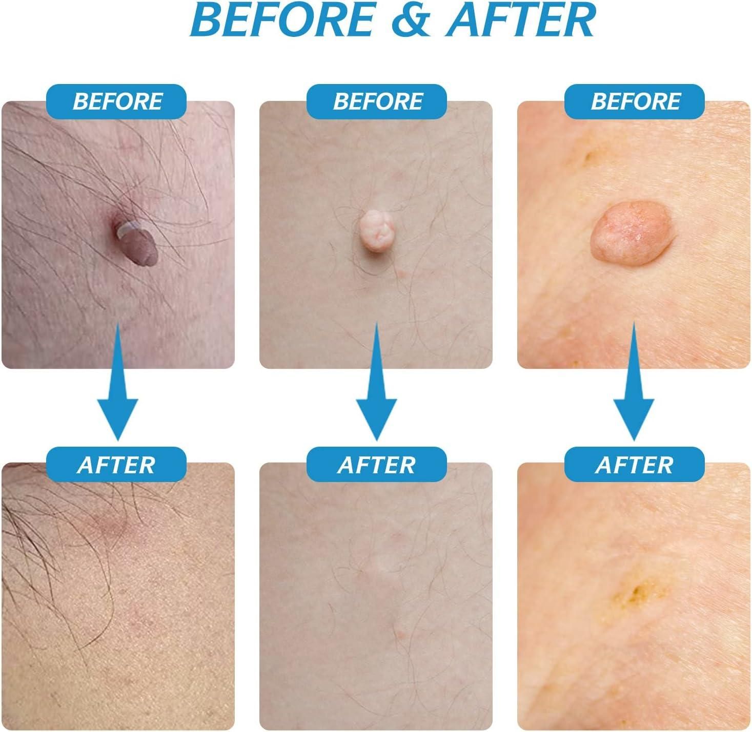 2 in 1 Skin Tag Remover Kit - Painless - Shopsmart9